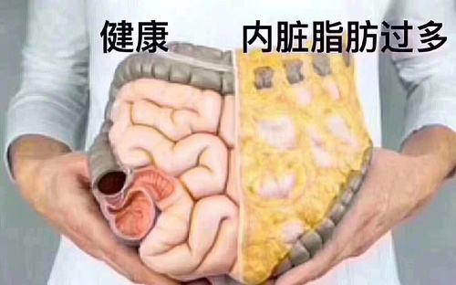 内脏肥胖者的特征科研发现,内脏脂肪和皮下脂肪存在并发的关系,内脏